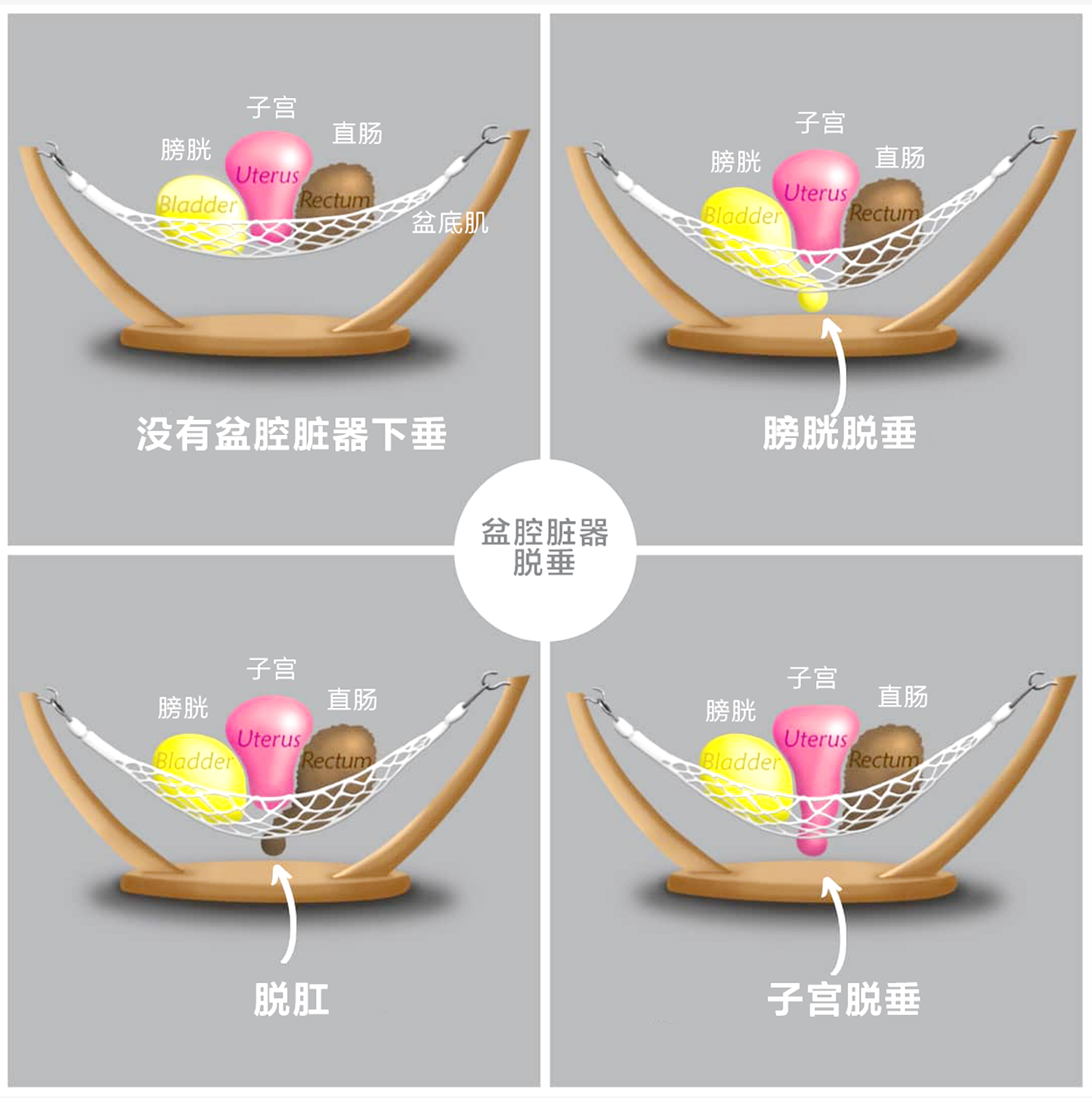 盆底肌肉修复（3）